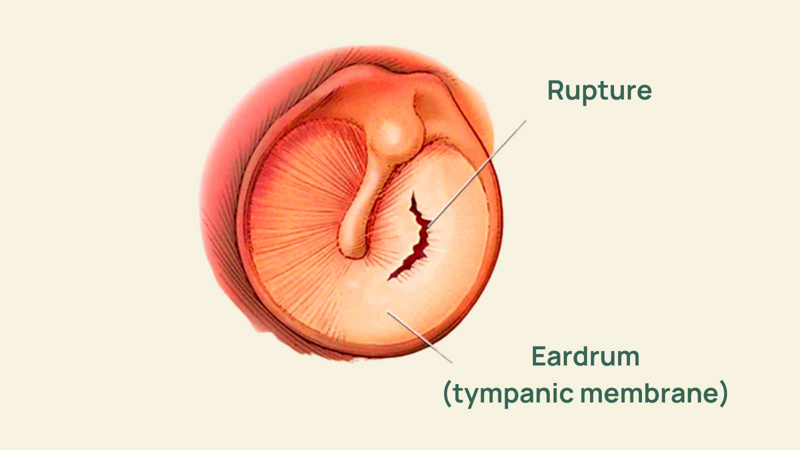 What Does a Tympanometry Test Do? Should I Get One?